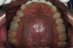 Figure 10  Superior teeth after treatment and occlusal adjustment.