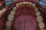 Figure 11  Inferior teeth after rehabilitation treatment and occlusal adjustment.