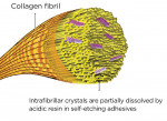 Figure 2  After etching dentin with self-etching adhesives, all of the extrafibrillar apatite fibrils have been removed to provide channels for infiltration of adhesive monomers and space for micromechanical retention. Note the residual presence of i