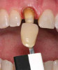 Fig 17. A layer of dHACM was placed to seal the healing abutment–soft-tissue gap, saturated with saline, and secured with 4-0 chromic gut.