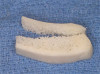 Fig. 2. The patient’s fractured denture was temporarily repaired using PMMA autopolymerizing acrylic resin, ensuring occlusion and vertical dimension was not altered.