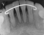 Figure 2  Intraoral periapical (IOPA) x-ray showing the interproximal bone loss in relation to the lower right central incisor.