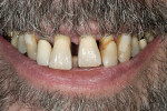 Figure 2  Full smile shows several millimeters of gingiva beyond the CEJ of the entire upper arch.