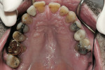 Figure 4  Structurally compromised posterior teeth; no active caries.