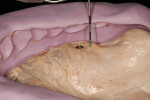 Figure 10  Master model with silicone matrix of the final wax try-in, demonstrating the closest distance from the fixtures to the desired occlusal plane (upper left).
