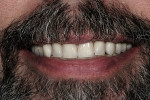 Figure 15  Final full facial view demonstrating reduced gingival display.