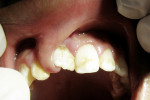 Figure 1  Smooth, exophytic, firm growth attached to the underside of the upper lip and extending between the maxillary right central and lateral incisors. Note the mesiolabial migration of the maxillary right central incisor. The sessile growth was