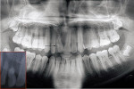 Figure 3  An orthopantomograph and periapical radiograph (inset) revealed shortened cervical-third and dilacerated root of the maxillary right central incisor.