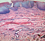 Figure 5  Photomicrograph exhibiting the overlying epithelium of the lesion and cellular connective tissue containing islands of odontogenic epithelium (hematoxylin and eosin stain, x10).
