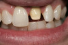 Figure 1. Root surfaces that have been exposed through gingival recession are susceptible to dentinal hypersensitivity. In these three examples, the non-carious cervical lesions on the facial surfaces of the maxillary teeth all exhibited symptoms of dentin hypersensitivity and were in need of restoration.