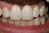 Figured 2. Root surfaces that have been exposed through gingival recession are susceptible to dentinal hypersensitivity. In these three examples, the non-carious cervical lesions on the facial surfaces of the maxillary teeth all exhibited symptoms of dentin hypersensitivity and were in need of restoration.