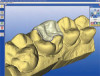 Fig 9. Balanced articulation in lateral excursion of the mandible: left balancing side.