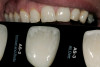Figure 3. Root surfaces that have been exposed through gingival recession are susceptible to dentinal hypersensitivity. In these three examples, the non-carious cervical lesions on the facial surfaces of the maxillary teeth all exhibited symptoms of dentin hypersensitivity and were in need of restoration.