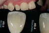 Figure 4. Exposed dentin can exhibit dentin hypersensitivity. Figure 4 is an example of enamel loss with exposed dentin caused by tooth attrition. Figure 5 is an example of enamel loss with exposed dentin caused by bulimia. The treatment in both cases was full-coverage crowns.