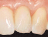 Fig 8. Caries prevention with SDF is critical on distal surfaces of primary second molars to avoid caries infection on mesial surfaces of permanent first molars. Note the Class 2 restorations in both primary molars in this 9-year-old patient whose first molar needed occlusal resin-based composite restoration.