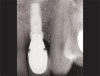 Fig 10. Interproximal sites in orthodontic patients can also benefit from preventive or interceptive SDF applications.