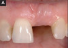 Fig 17. A 15-year-old girl with retained mandibular primary second molar and congenital absence of second premolar (Fig 16). In bitewing film small radiolucencies revealed beginning caries lesions at contact points of primary second molar and adjacent first molar (Fig 17); 12 months later, after initial SDF and 6-month follow-up SDF applications (Fig 18), radiolucencies were not evident.