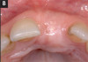 Fig 18. A 15-year-old girl with retained mandibular primary second molar and congenital absence of second premolar (Fig 16). In bitewing film small radiolucencies revealed beginning caries lesions at contact points of primary second molar and adjacent first molar (Fig 17); 12 months later, after initial SDF and 6-month follow-up SDF applications (Fig 18), radiolucencies were not evident.