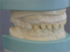 Fig 3. Screw-retained implant crowns.