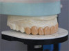 Fig 4. Two-piece, screw-retained implant crown and abutment. The crown is cemented to the abutment outside of the mouth.