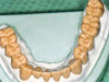 Fig 7. Fabrication of screw-retained crowns. Note the limited occlusal clearance.