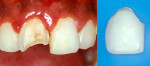 Figure 1  Clinical views showing (left) the permanent maxillary right central incisor with swollen marginal gingiva and extensive crown fracture, and (right) the coronal fragment resembling a laminate veneer.