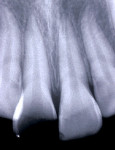 Figure 2  Radiographic view showing no alterations in the radicular or periodontal structures of the fractured tooth and absence of periapical lesion.