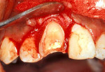 Figure 4  Full-thickness flap was elevated to expose the subgingival level of the fracture line.