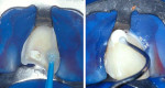 Figure 5   Adhesive tooth fragment reattachment technique. (left) Application of the etch-and-rinse adhesive system in preparation for attachment of the coronal fragment. (right) Filling of the cervical portion of the fracture line with resin-modifie