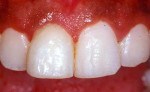 Figure 7  Final clinical aspect of the tooth crown after adhesive fragment reattachment and finishing/polishing procedures.