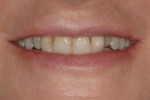 Figure 2  Pretreatment image of the patient’s close-up smile.
