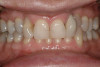 Fig 4. Severe recession visible on teeth Nos. 29 and 30.