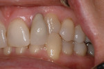 Figure 4  Close-up view of the reverse articulation of the maxillary and mandibular left canines.