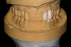 Fig 7. Close-up view of the No. 23 implant-supported restoration showing inflammation surrounding the site (this area had not been grafted).