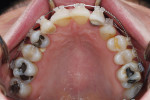Figure 7   Occlusal view of the maxillary arch during orthodontic therapy with fixed appliance.