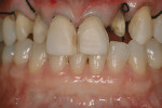 Figure 10  Tooth preparations for the all-ceramic restorations. Note that the preparations for veneers are conservative and are on enamel.