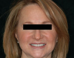 Figure 13  Posttreatment full-face image of the patient in smile. The midline deviation to the right is within tolerable limits.