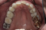 Figure 7  Extensive restorations with structural compromises. Note the ectopic tooth locations.