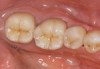 Fig 1. The outline form of a square tooth shows an incisal edge that is straight or slightly curved.