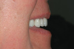 Figure 13  Ideal horizontal and vertical placement of maxillary incisal edges.