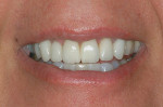 Figure 14  Intra-arch tooth position was corrected and gingival asymmetry improved.
