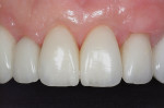 Figure 16  Gingival discrepancy between tooth Nos. 7 and 11 was improved.