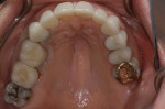 Figure 18  The patient elected not to replace tooth No. 2.