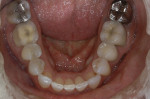 Figure 19  The caries control program and improved diet minimized erosion and decay.