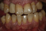 Figure 1  Preoperative intraoral photograph with frontal view.