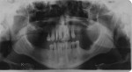 Figure 2  Preoperative orthopantomography.