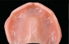 Fig 5. Age 15. Facial view of the developing ridge after removal of coronal segment of tooth No. 8.