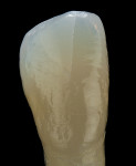 Figure 2 Translucent enamel not backed by dentin is easier to see. The translucency of the enamel is often evaluated by observing the amount and location of the opalescent blue enamel.