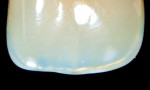 Figure 4 The incisal halo will display both blues and red-yellows depending on how the various wavelengths are bent or bounced around within the body of enamel. The angle of illumination will change the visual display.