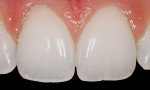 Figure 7 Heavy vertical surface textures are highlighted by specular reflections off the heights of contour. These reflections give anterior teeth their perceived shape and width. These teeth are also showing “orange peel” surface textures.